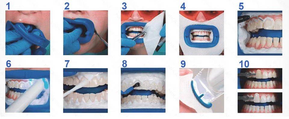 2 Person Complete Procedures Teeth Whitening Kit N568171